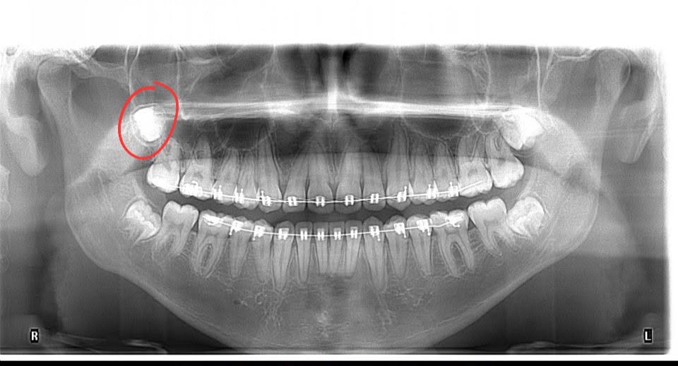 Radiografía panorámica a los 16 años mostrando cordal impactada