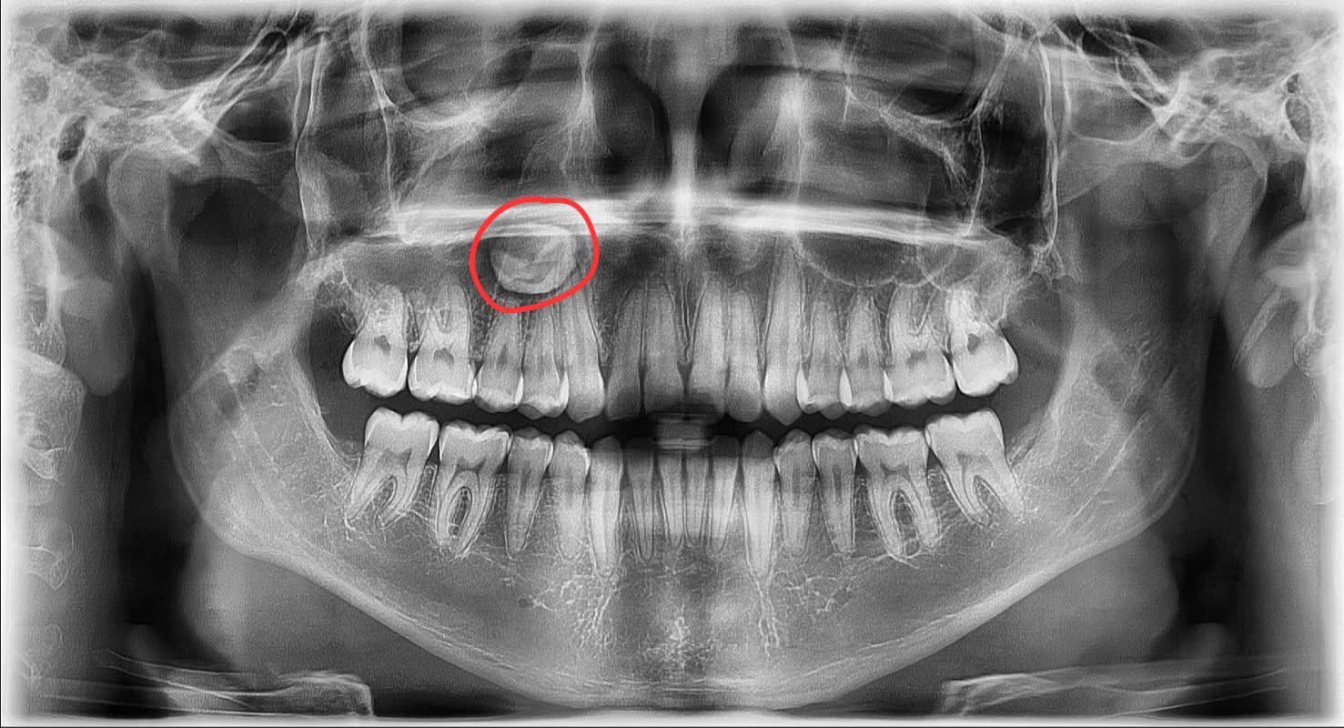 Radiografía panorámica a los 17 años mostrando cordal desplazada al cuello