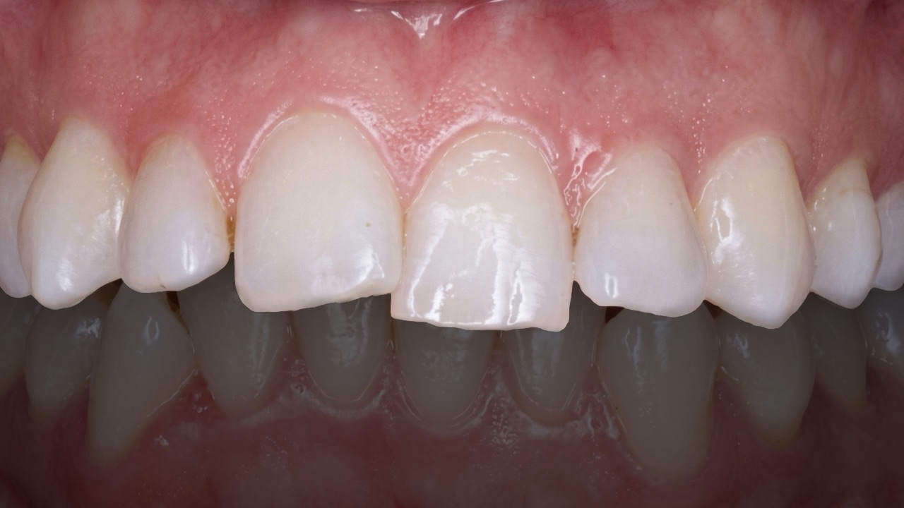 Antes del tratamiento