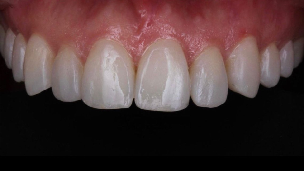 Después del tratamiento