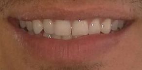 Antes del tratamiento