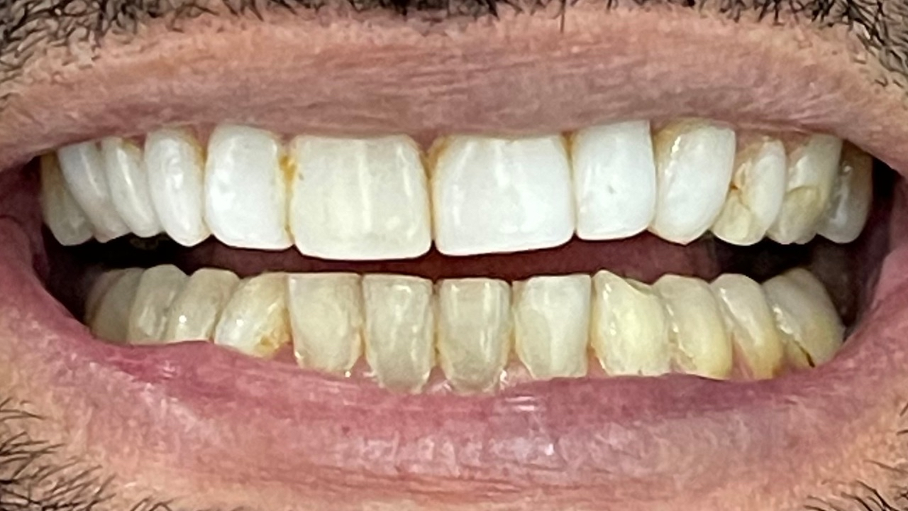 Antes del tratamiento