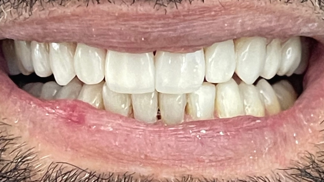 Después del tratamiento