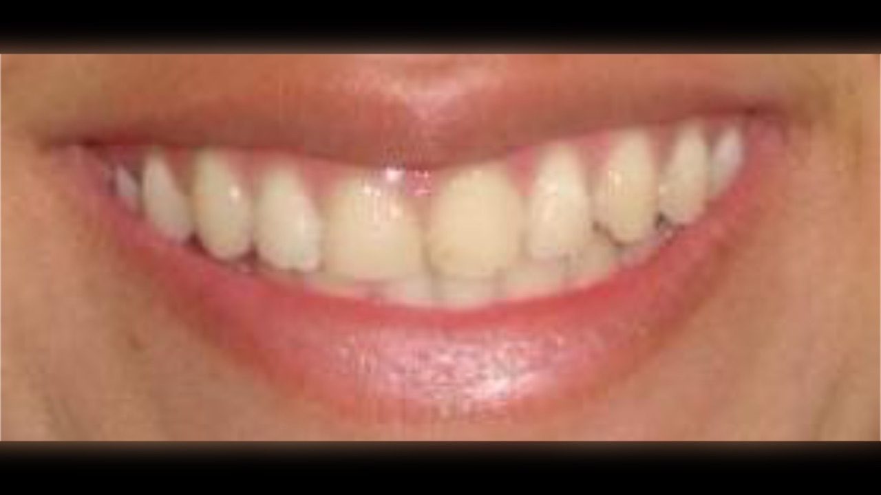 Antes del tratamiento