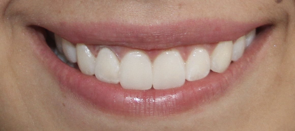 Después del tratamiento