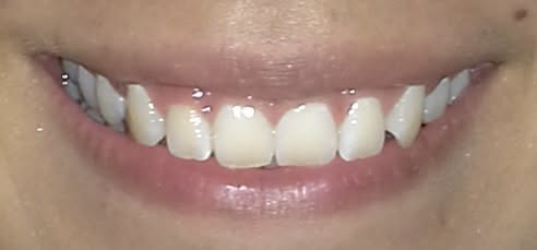 Antes del tratamiento